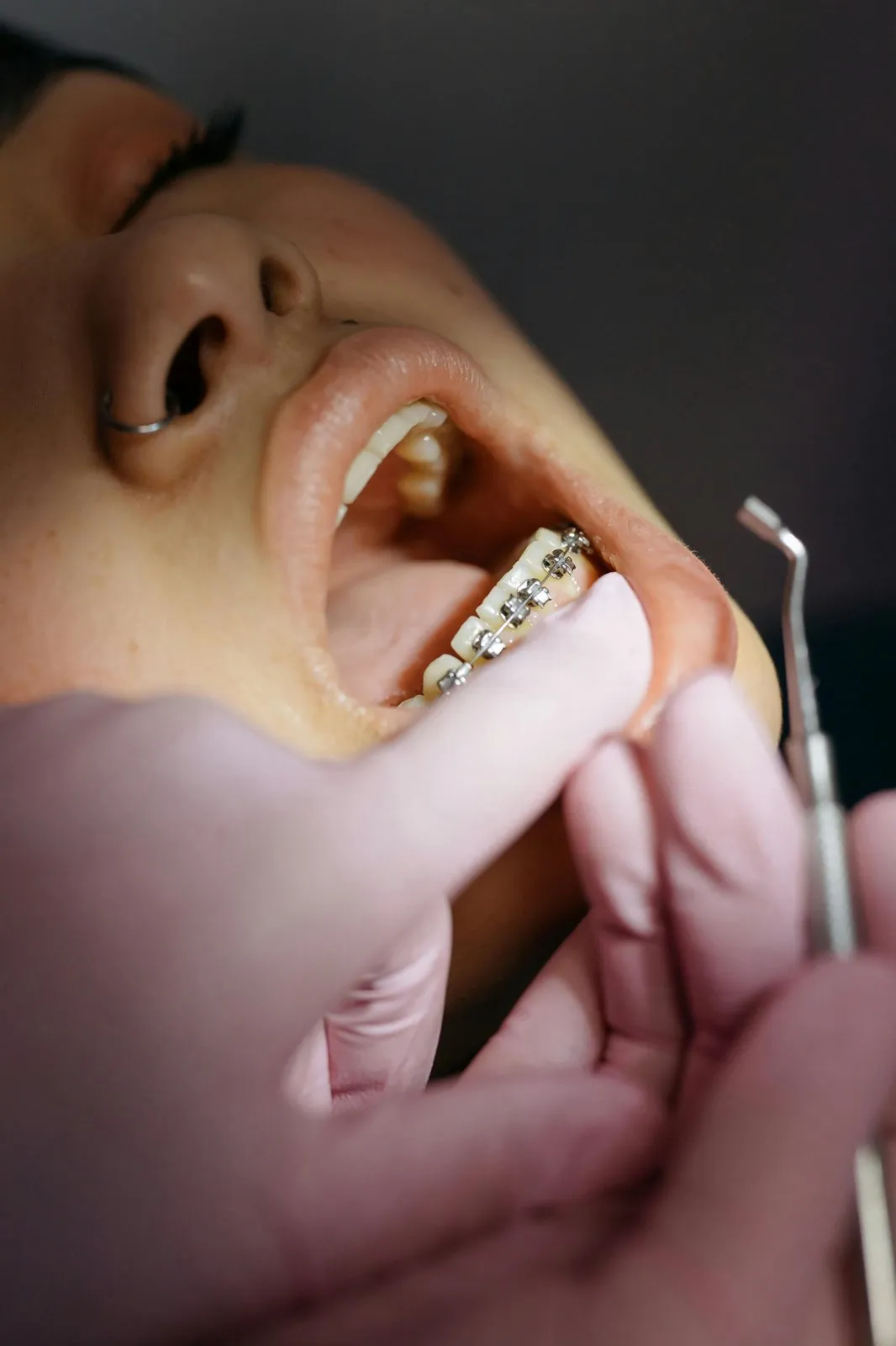 Braces